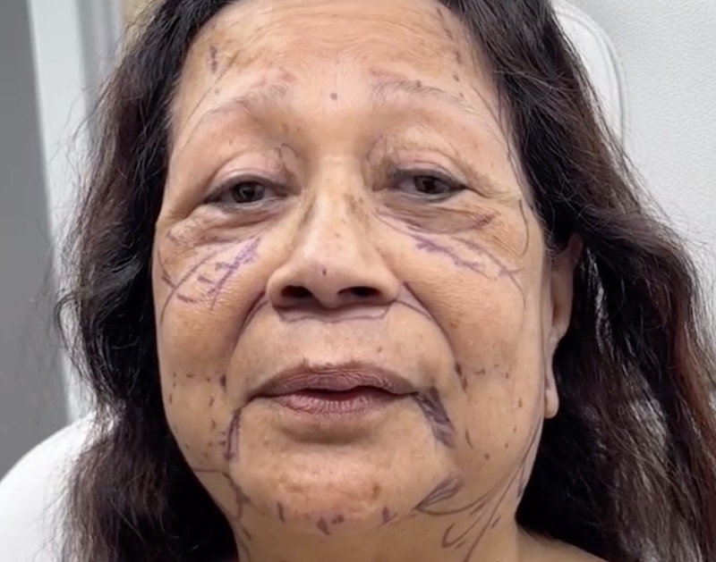 This Old Grandma Got a Facelift and She Looks 20 Years Younger After